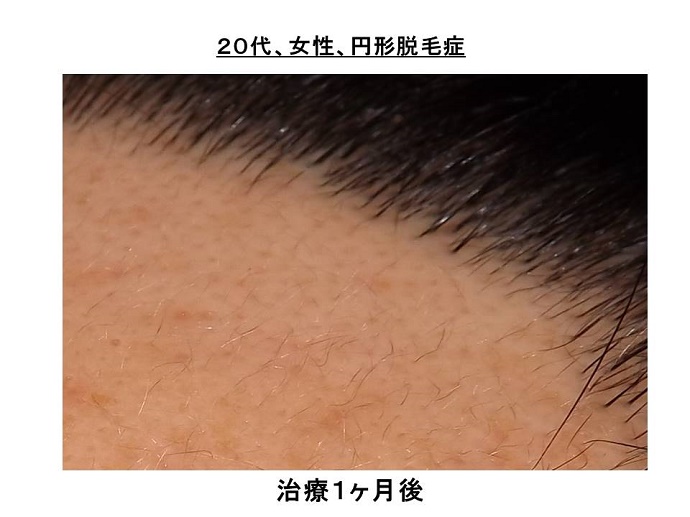 円形脱毛症　病院""